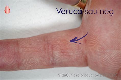 Veruci cutanate sau Negi 👉 Etiologie și tratament Vitta Clinic
