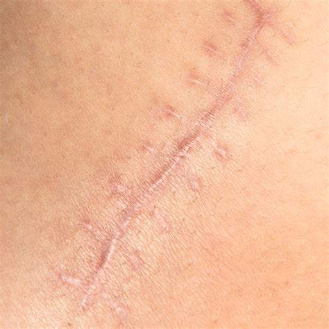 scar revision experia advanced skin hair clinic