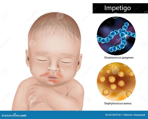 Impetigo Is An Infection Caused By Strains Of Staphylococcus Or ...