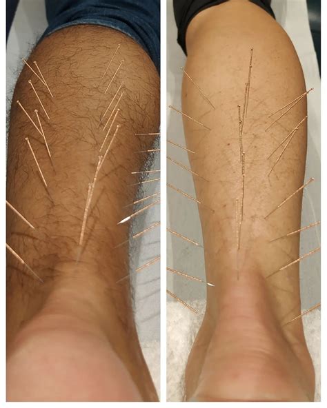 Physiomedica - Achilles tendinopathy is an injury to the band of tissue