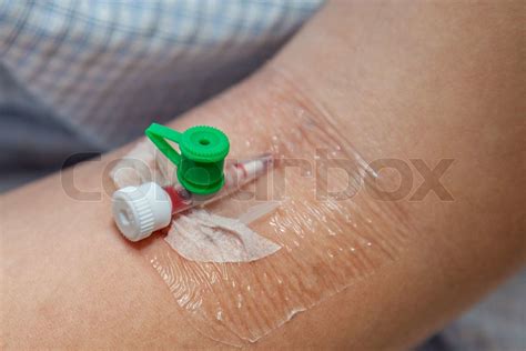 catheter   vein stock image colourbox