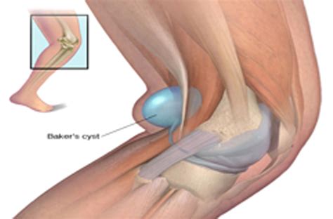 Popliteal Cyst(Baker Cyst)