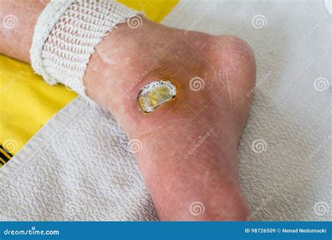 Diabetic Foot stock image. Image of cleaning, diabetes - 98726509