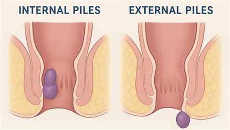 how to know if i have piles