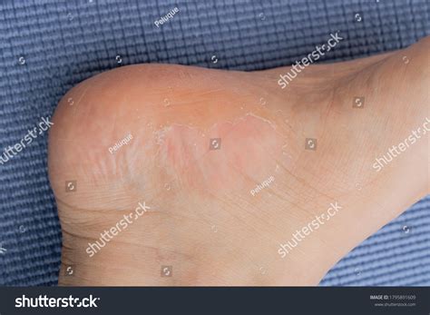 Melanoma Foot: Over 88 Royalty-Free Licensable Stock Photos | Shutterstock