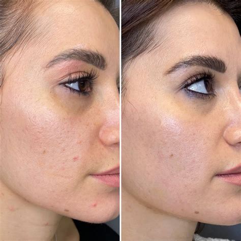 Лазерный эндолифтинг - SWISS BEAUTY CLINIC