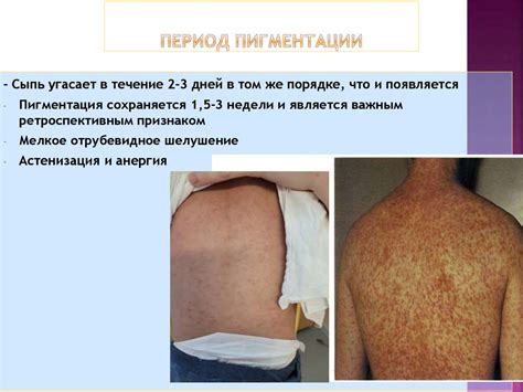 Корь у детей - презентация онлайн