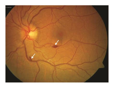 Fundus photo of the left eye demonstrating optic nerve head edema with ...