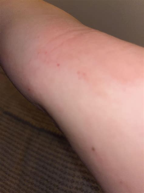 Ringworm and fluconazole : r/skin