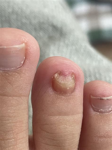 Nail Fungus: real advice from real people for healthy toenails and ...