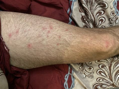 Что это прыщики или сыпи - Вопрос дерматологу - 03 Онлайн