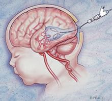 Vein of Galen Malformation » Lillian S. Wells Department of ...