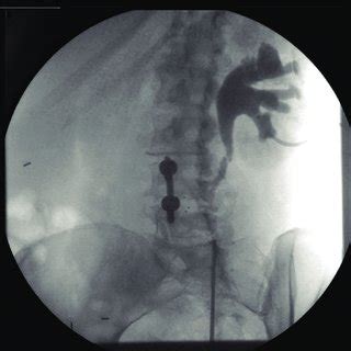 MAG-3 lasix renal scan performed 3-months following left hand-assisted ...