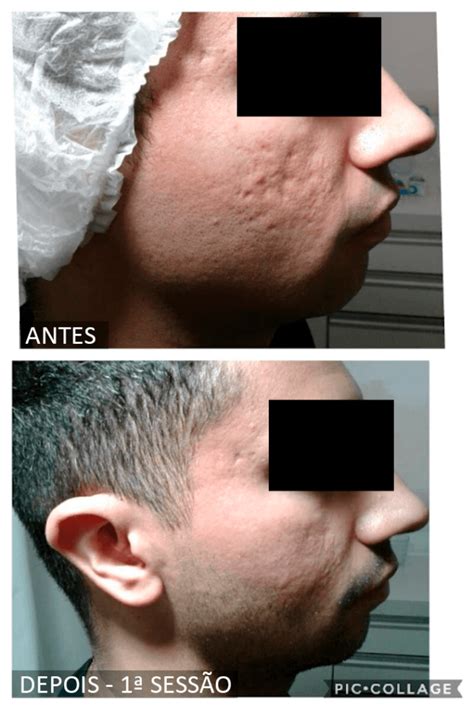 Rejuvenescimento Íntimo Antes E Depois - Workshop: Rejuvenescimento Íntimo - Dra. Marília Machado