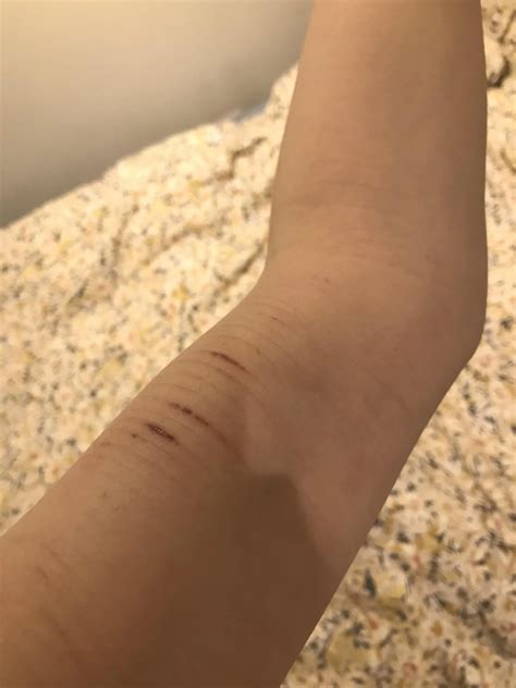 Why is there bruising under my scars after months of healing?? Has