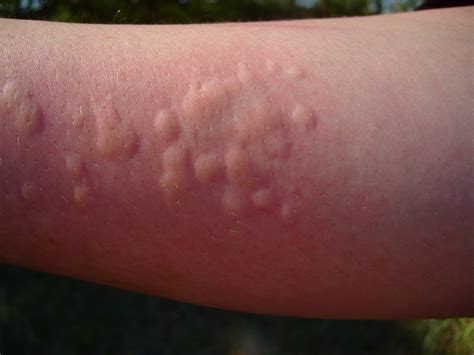 What Does Nettles Look Like On Skin at Tashia Wood blog