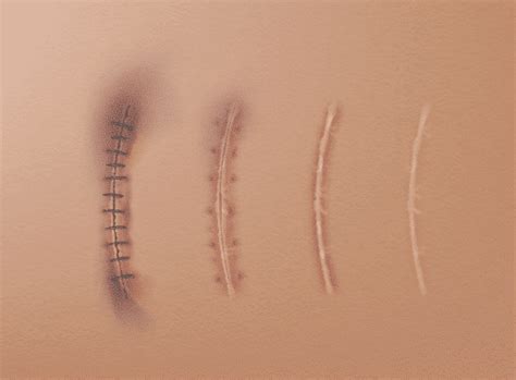 how long does it take a surgical incision to heal