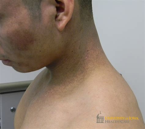 Brown-gray ill-defiend patches on the cheeks and neck. (click images