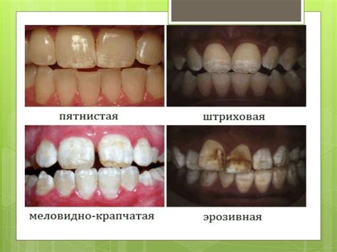 Флюороз и его профилактика - презентация онлайн