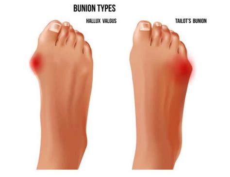 pinky toe turned sideways     treatments explained