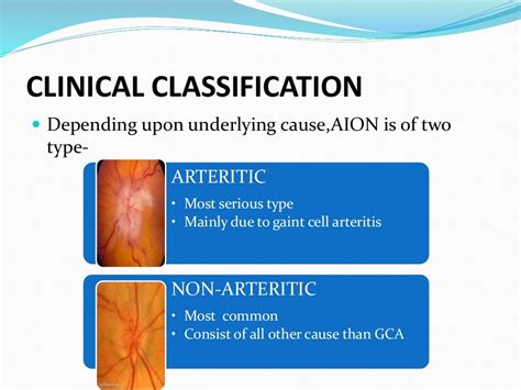 Ischemic optic neuropathy