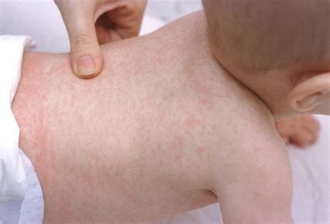 Roseola | Annapolis Pediatrics