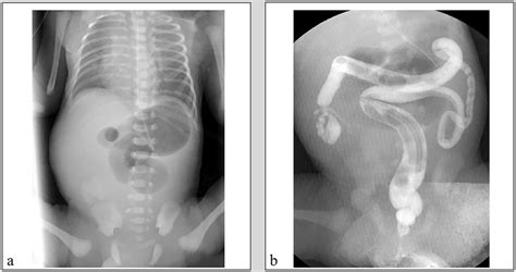 a Abdominal plain radiography shows the dilated upper jejunum. b ...