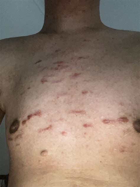 Spontaneous Keloids : r/Keloids
