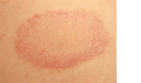Viral Skin Infections