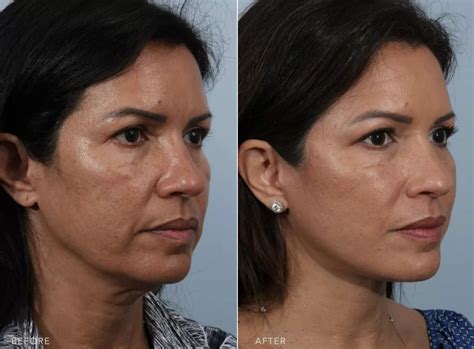 How much does a mini facelift in Tijuana Mexico cost? - Top Surgeons Mexico