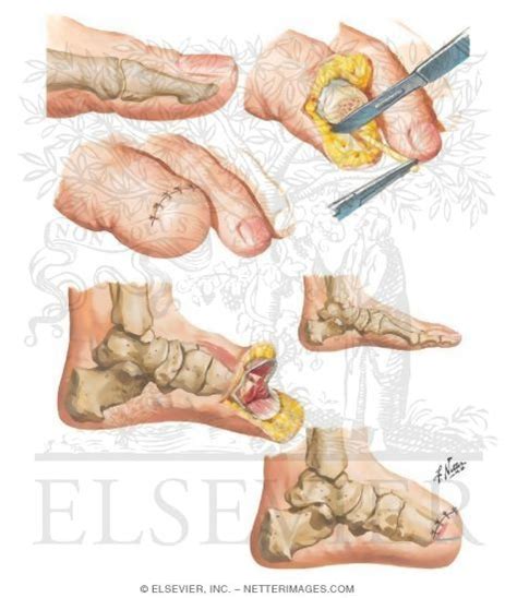 Toe Amputation - Transmetatarsal Amputation