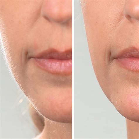 Magnitone DermaQueen Vibra-Sonic Facial Hair Removal + Dermaplane