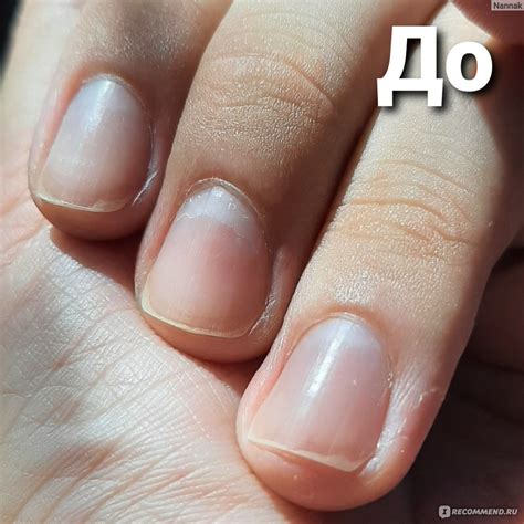 Птеригий На Ногтях Фото - 63 Фотo