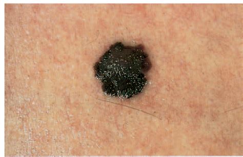 Skin Cancer Photos Melanoma