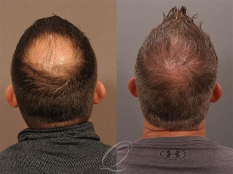 Male FUE Hair Transplant Before and After Pictures Case 1001537 ...