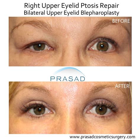upper blepharoplasty  wrong dr prasad blog