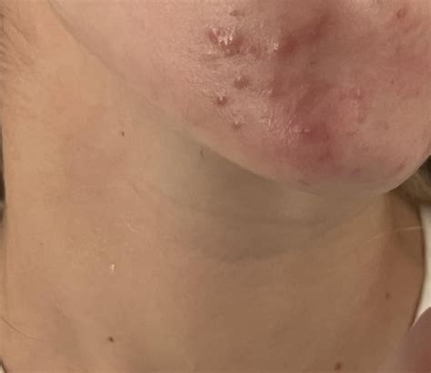 Nexplanon acne : r/Nexplanon