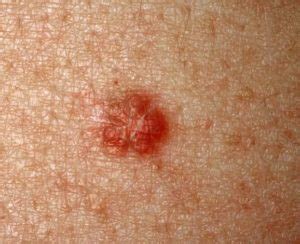 Skin Cancers and Lesions – The Skin Cancer Doctor