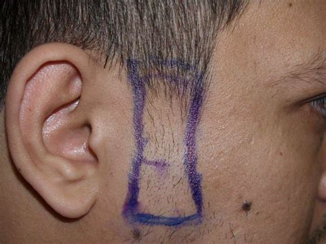 Surgical Hair Transplant Services at Rs 45/graft in Ahmedabad | ID ...