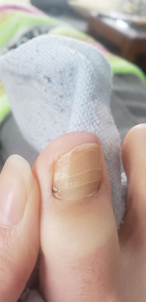 nail fungus rnailfungus