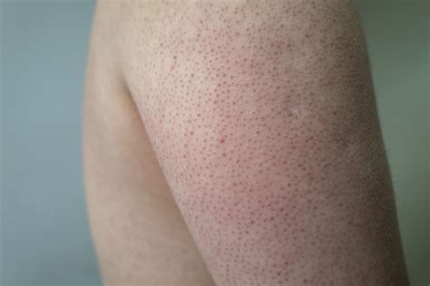 keratosis pilaris  weird skin bumps