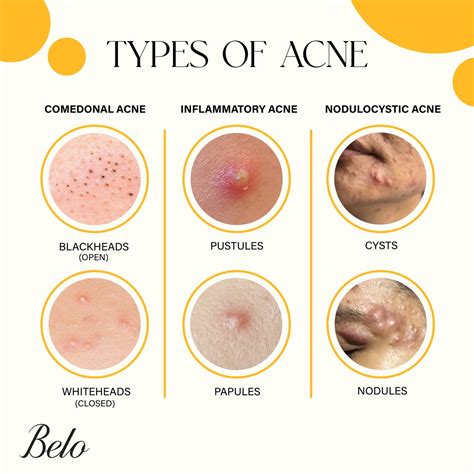 Understanding Acne: Common Types and Triggers