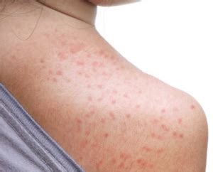 Mold on Skin: Causes, Symptoms & Treatment - Mold Fix