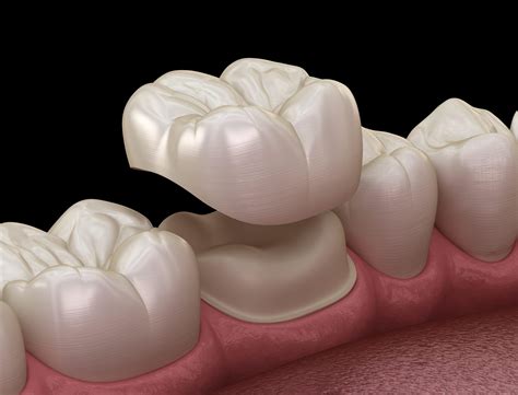 molar crown