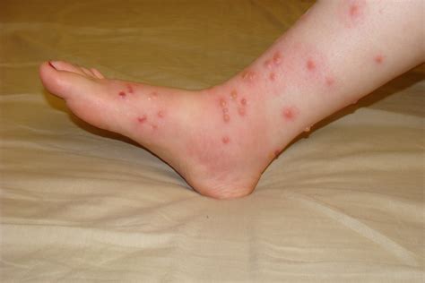 Poison Ivy Bumps On Skin