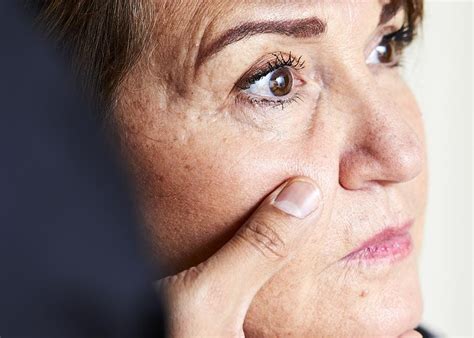 age spots treatment essex treat age spots