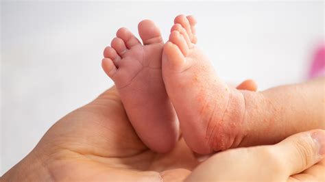 Foot Dyshidrotic Eczema: Symptoms And More, 50% OFF