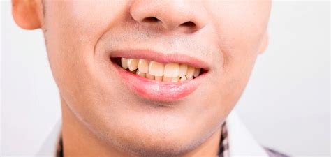 What causes yellow teeth and discolouration | Signal
