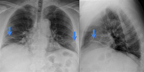 Ателектаз — 24Radiology.ru