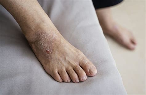 Foot Allergies? Yes, They Exist! - Feet First Clinic